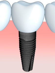 dentin implants