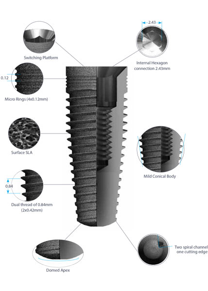 dental implants prestige-details